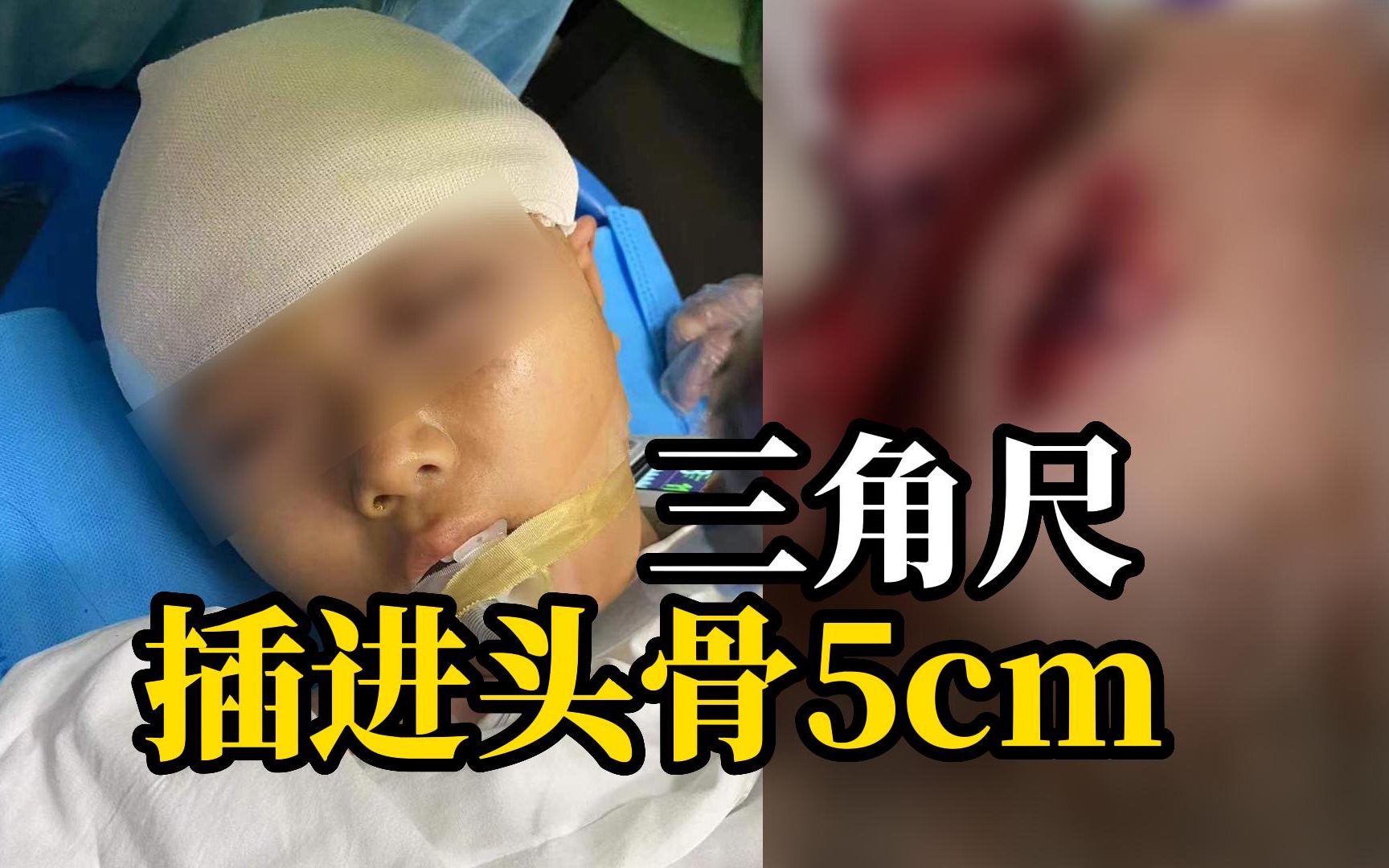 孩子遭老师用三角尺击伤头骨进ICU,官方通报: 学校党总支书记和涉事教师停职哔哩哔哩bilibili