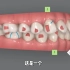 【隐适美案例分享】成年人龅牙+牙龈萎缩的牙齿矫正全过程