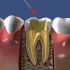 爱牙网：3D根管治疗演示VS真人根管治疗演示
