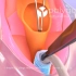 喉癌喉咙切除外科重建术动画片