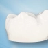 【深圳牙冠】什么情况要进行牙冠修复呢？牙冠修复过程是怎样的呢？会很痛吗？