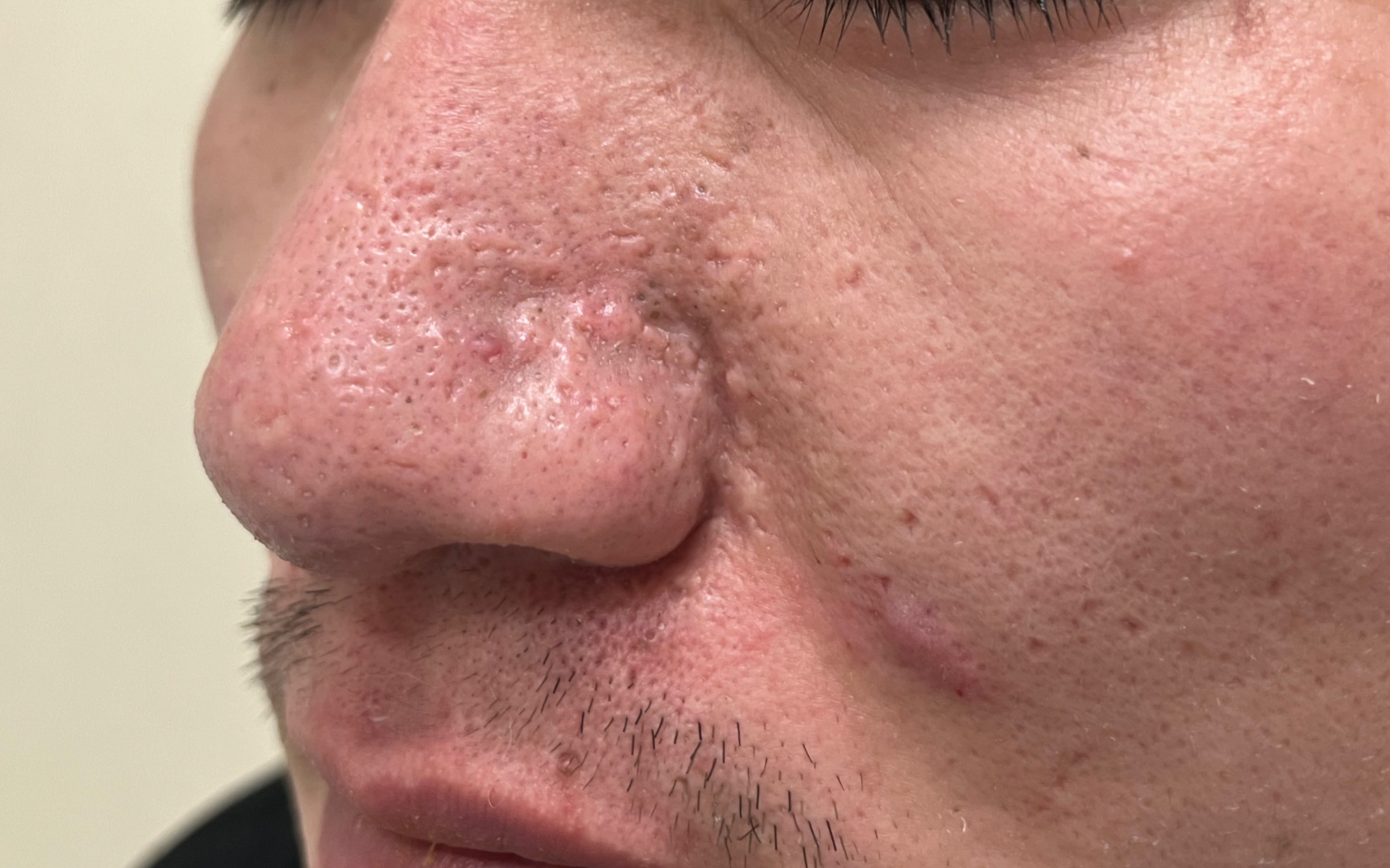 鼻头皮脂腺增生疤痕，反复长痘感染造成的凸起疤痕
