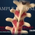 【中字|3D医学动画】脊柱侧弯的危害与治疗