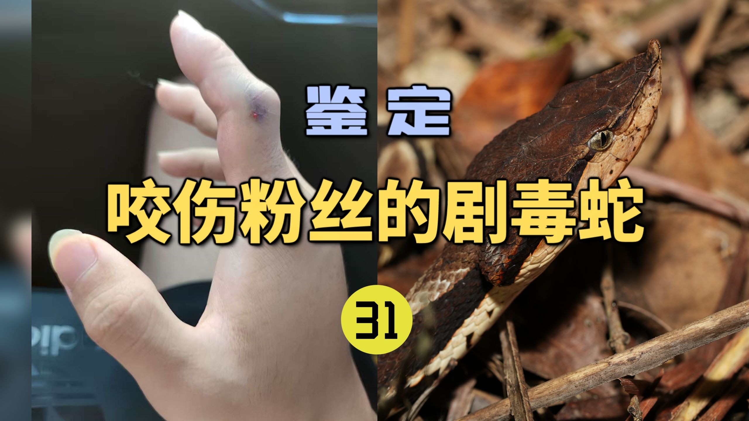 鉴定咬伤粉丝的毒蛇(31)医生粉丝遇不明毒蛇咬伤！龙雅分析出是五步蛇？