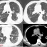 刘敏:间质性肺疾病的影像学表现