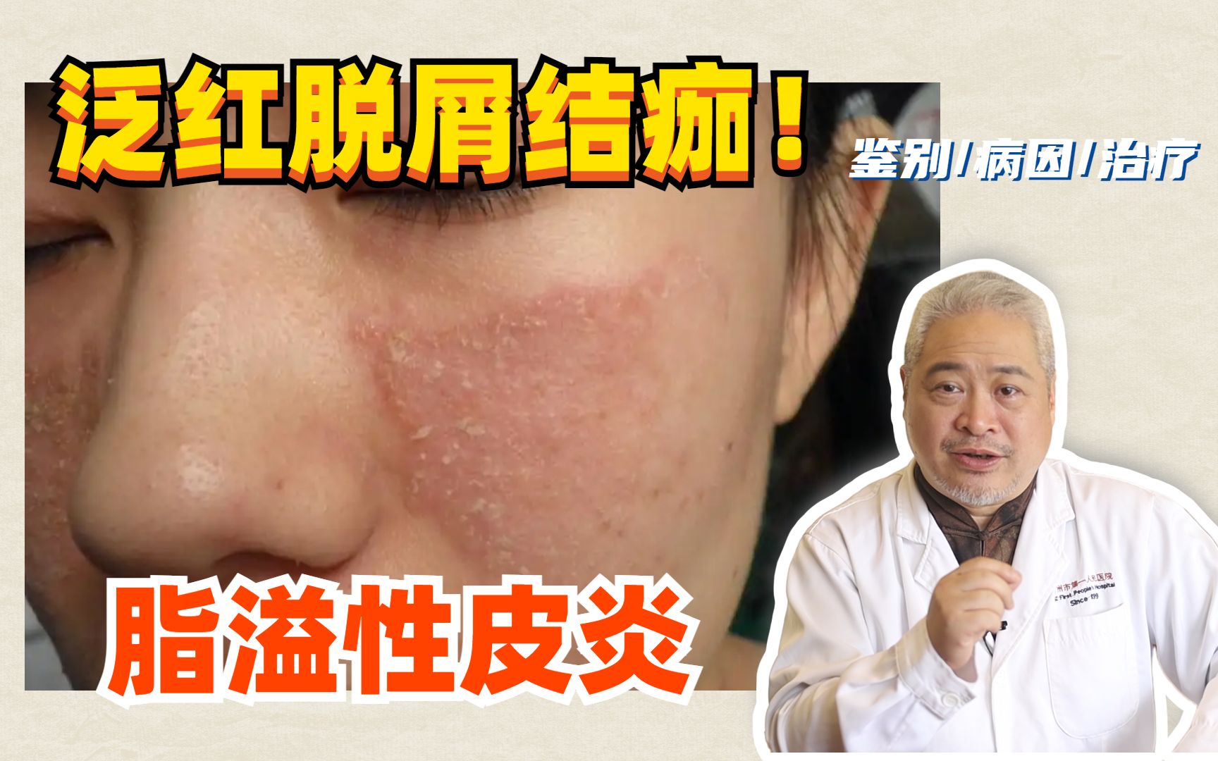 【皮肤科教授】脸上泛红脱屑，油油腻腻的，脂溢性皮炎怎么办？
