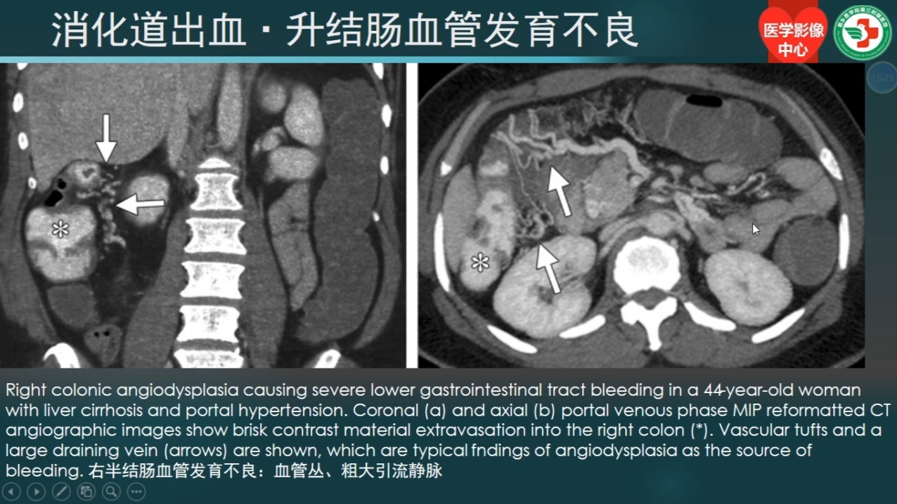 第十二讲 消化道出血02（共30讲）