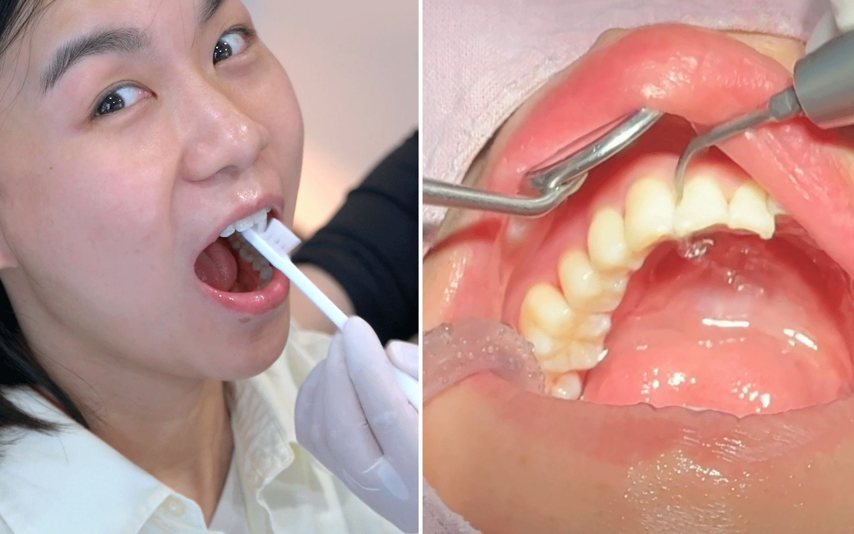 Not ASMR真实的洗牙过程 非助眠但有用的口腔护理方法