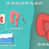 溃疡性结肠炎4：疯狂拉稀该咋治