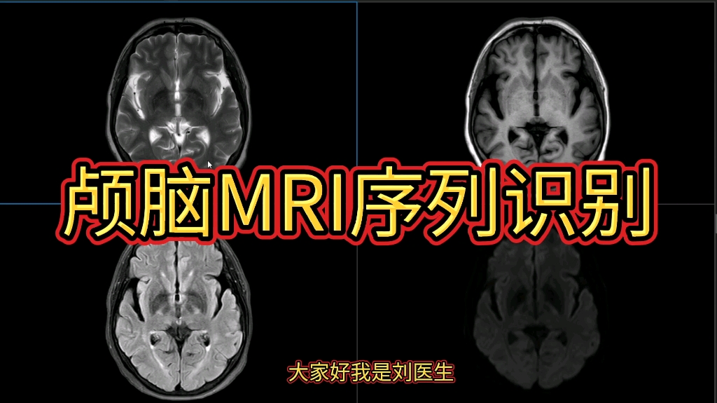 颅脑MRI基础：如何区分各序列MRI图像？医生讲解，初学者必看！