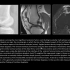 髌骨解剖及髌骨不稳的影像诊断+病例分析