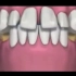 济宁牙科医院哪个好_后牙掉了不修复有影响可以做种植牙？壹颗芽口腔！