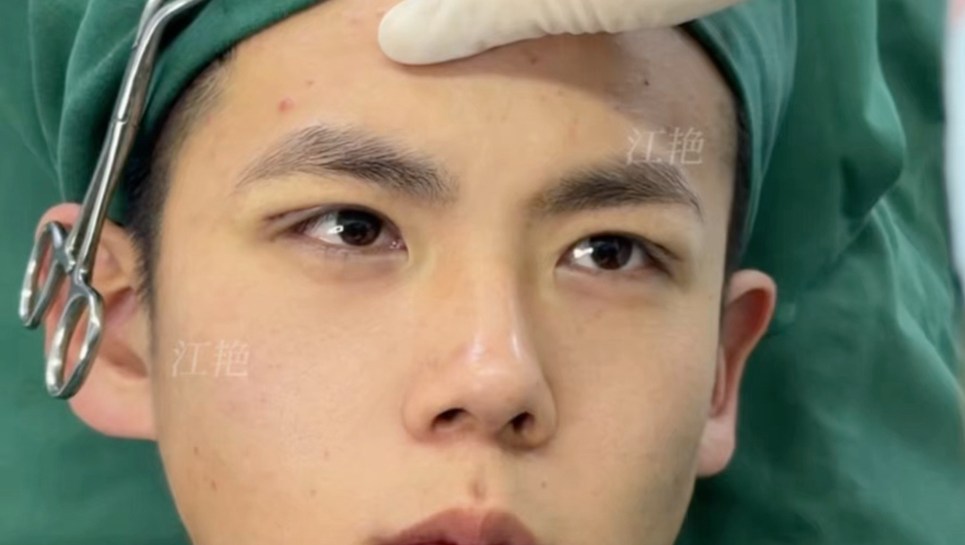 三角眼男生，双眼皮后反差有多大？