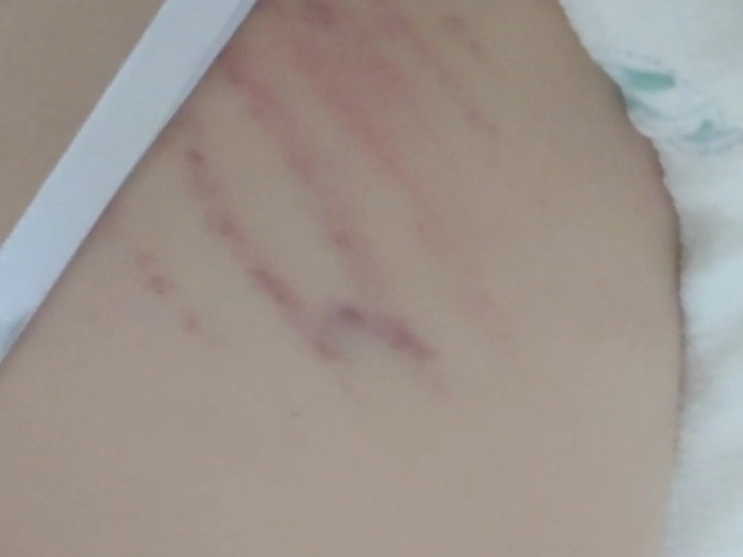 我本来觉得背好痛，想拿手机照一下，结果在摄像头里面看见这样的抓痕，我感觉好诡异你们懂不，真的好吓人，我每天两点一线，今天洗澡突然感觉背上刺痛，这是咋回事啊