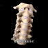 这手术就是在刀尖上跳舞，颈椎椎管狭窄手术过程，3D演示。。