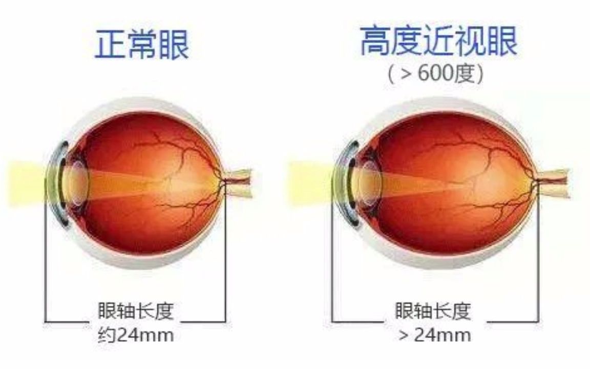 500度轻松恢复近视，近视眼怎么慢慢恢复视力,近视眼怎么恢复视力方法