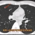 肺结节病例分享：这种肺部微小结节，几乎不用随访