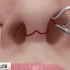 3D动画演示驼峰鼻矫正手术过程。