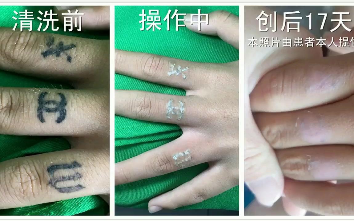洗纹身视频激光洗纹身几次洗干净邴力教授任意次数洗纹身彭于晏式的帅