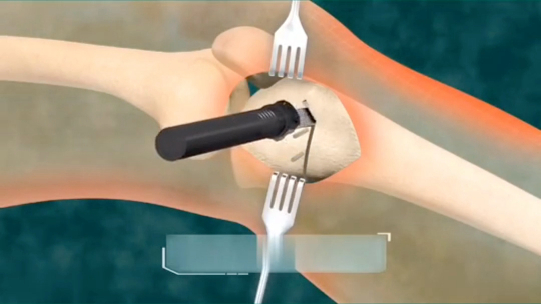 医学3D视频演示：O型腿矫正过程