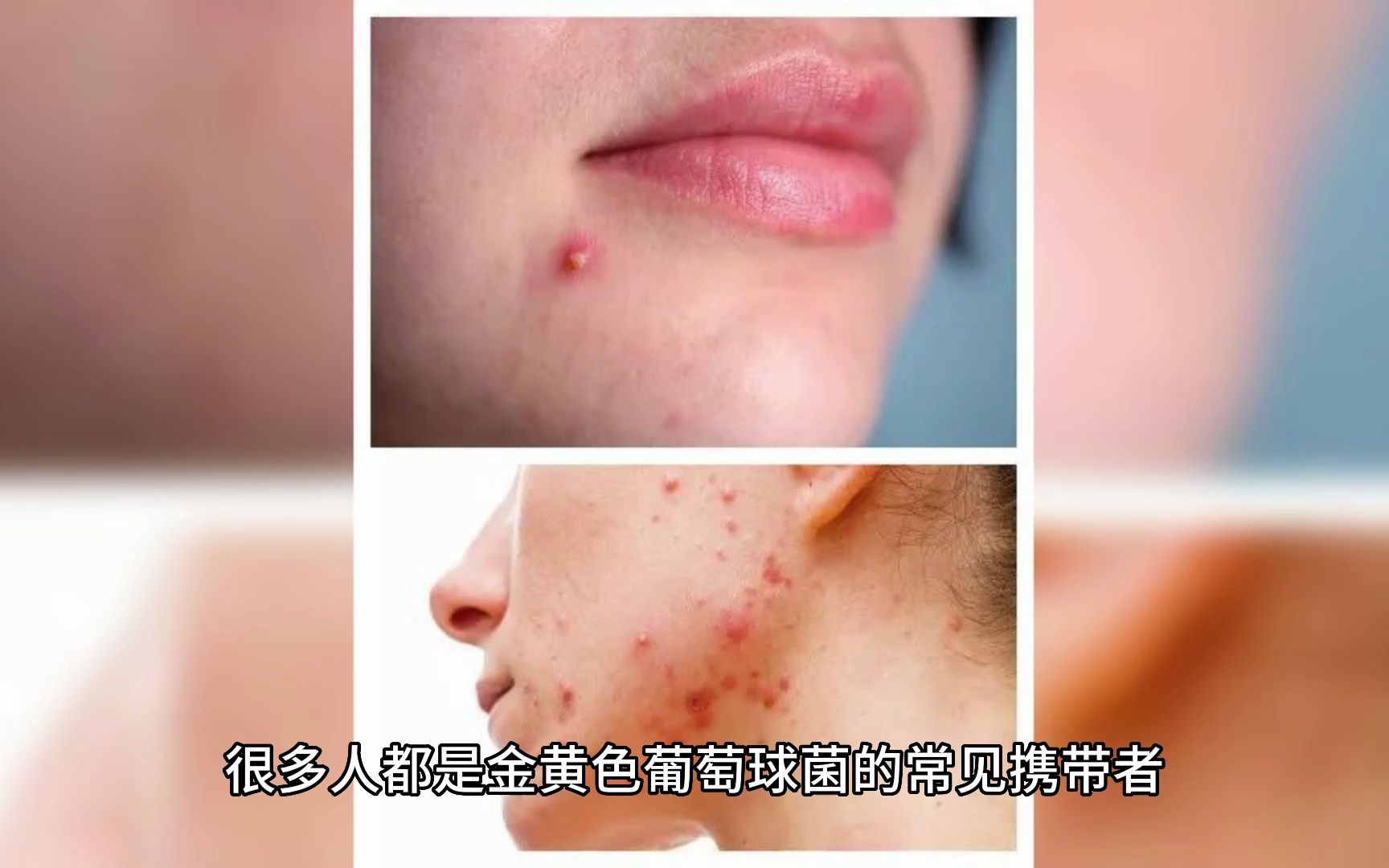 金黄色葡萄球菌