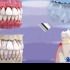 【动画演示】牙周炎发展过程，看看牙是怎么从牙龈红肿最后牙齿脱落的
