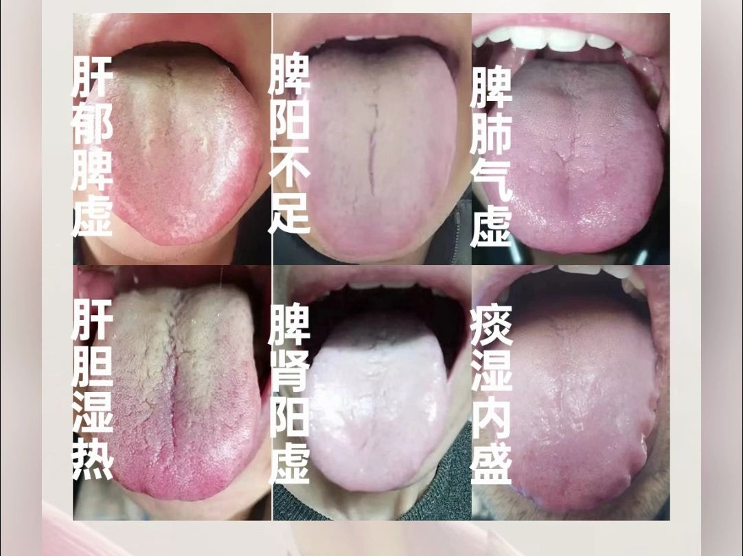 舌象分析：参苓白术散用对了，清除掉体内99%的寒湿、痰湿和湿热，还能补肾、益肺！