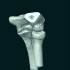 桡骨小头骨折的CT扫描VR重建图像