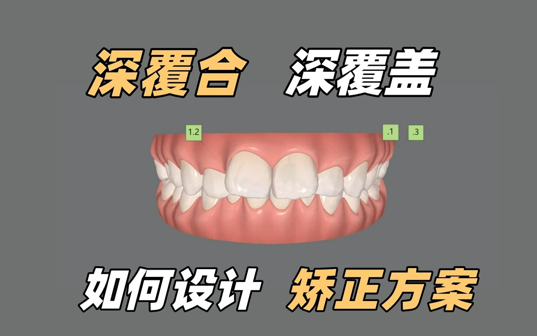 如何矫正深覆合深覆盖？矫正方案怎么设计？