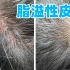 【小博门诊】头皮红斑，瘙痒，脱发，头皮屑多，治疗脂溢性皮炎其实不难