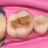 补牙全程视频，看看补牙时医生在你的嘴里做了什么，涨知识了