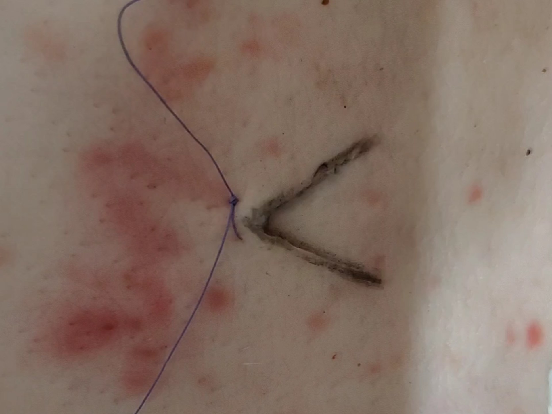 基本手术练习-9。三角形伤口的角缝合方式。