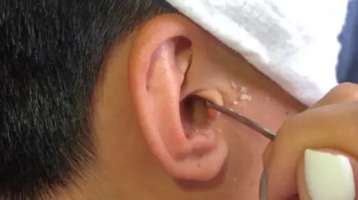 「耳屎大放送」后面有软膜护理
