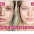 【化妆】跟油管上的姐姐学学痘痘肌护理My Acne Skin Care Routine