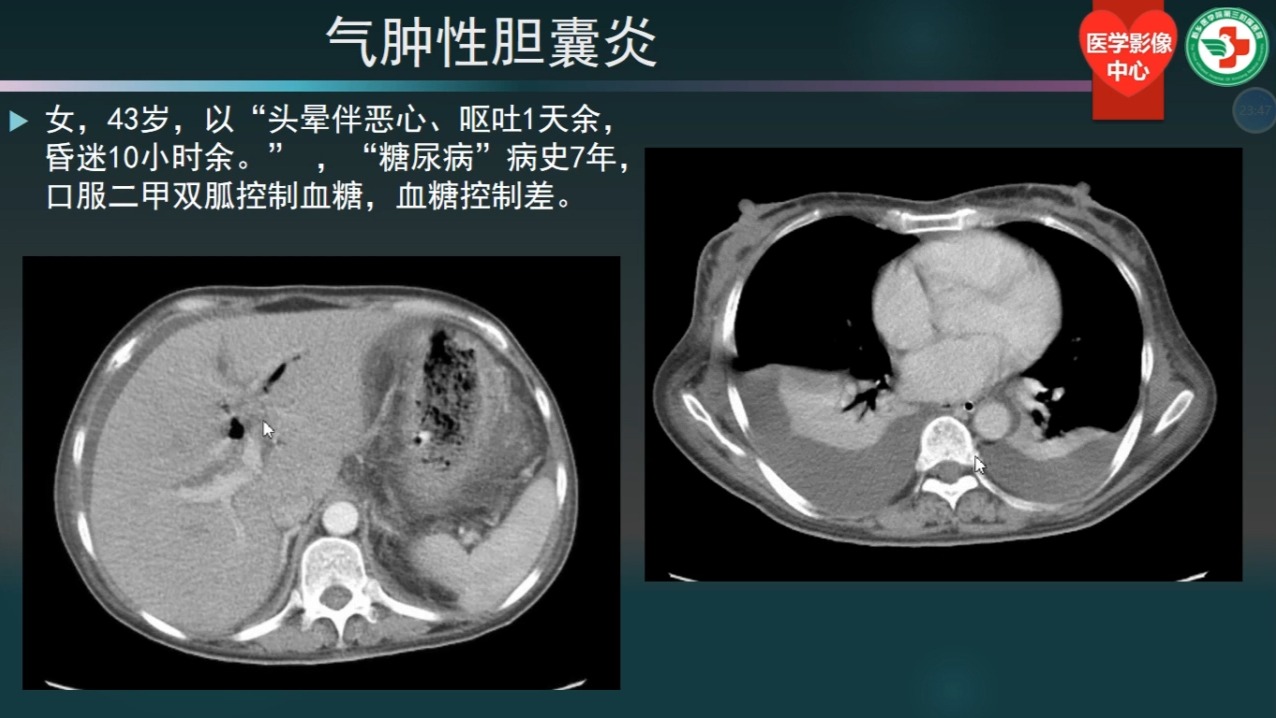 第二十四讲、胆道急腹症（共30讲）
