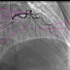 8.心血管影像解剖图谱-冠状动脉造影DSA-左冠状动脉解剖