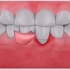 牙龈萎缩导致牙根外露怎么办？_