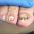 一位70岁的老人，因真菌感染导致指甲坏死