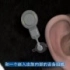 英国首位仿生耳植入患者 术后1小时恢复听力