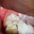 6岁后，孩子的这颗牙一定要及时做好窝沟封闭！