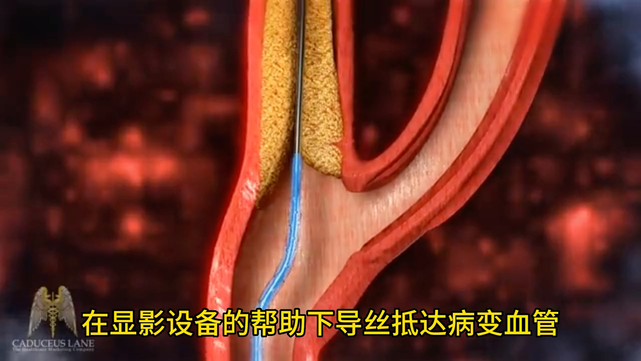 颈动脉狭窄支架置入过程演示，精品科普！