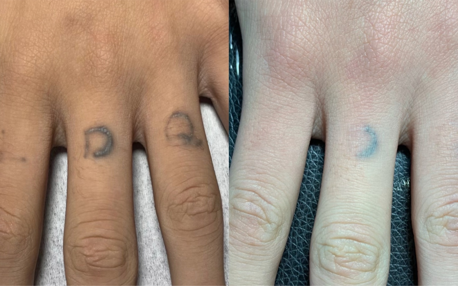 二手手指增生纹身清洗2次效果真实对比