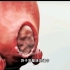 剖腹产同时切除子宫肌瘤手术过程，3D演示。。