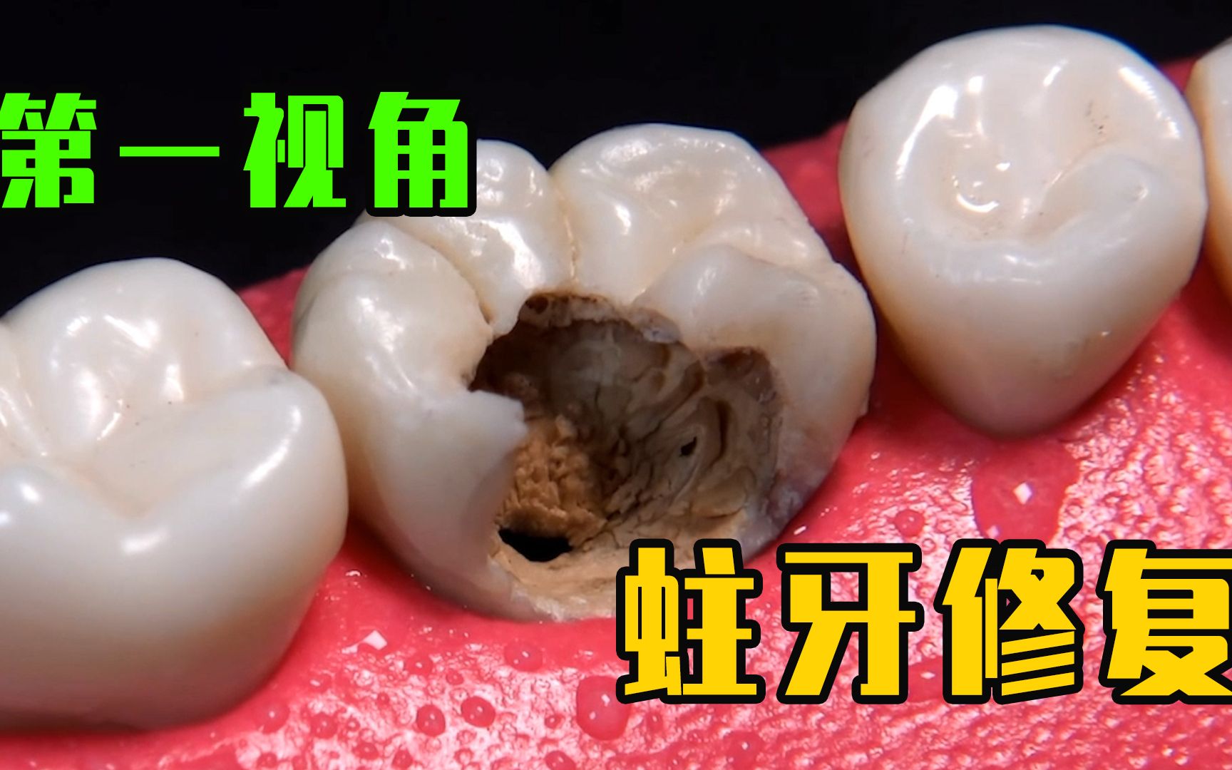 令人惊叹的蛀牙修复手术，被掏空的牙齿最后竟然能完美修复！