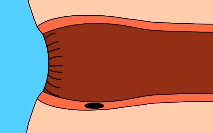 肛瘘是怎么形成的？动画演示