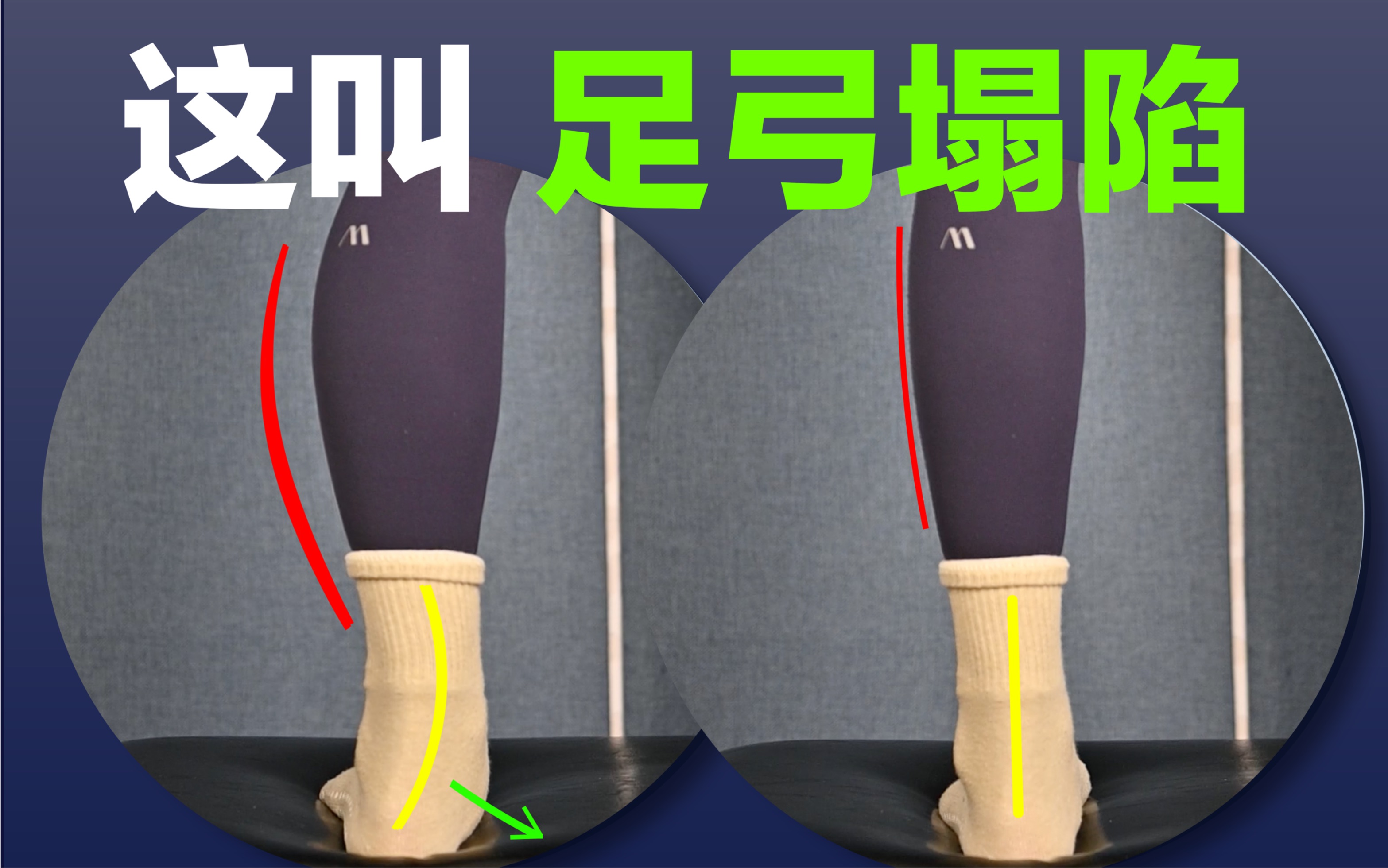 【一个动作矫正足弓】小腿外翻的原因是足弓塌陷