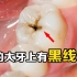 后牙上的黑线是蛀牙吗？为什么动物从来不刷牙，牙齿却能保持健康？