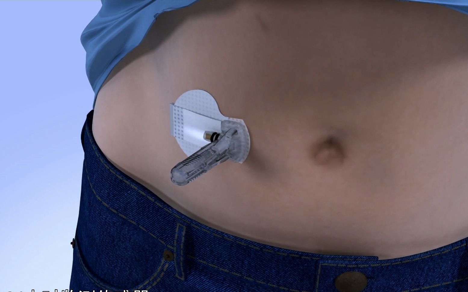 【无影灯下】看点16-2：糖尿病人的福音：体内植入监测器实时监控血糖
