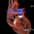 3d医学演示，4种先天性心脏病