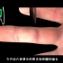 手指肌腱断裂缝合术，3D演示。。